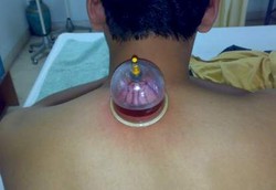 Bugar Kembali dengan Bekam