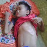 Bocah MI Alami Jantung Bocor Sejak Balita