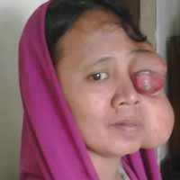 Sempat Tertunda, Nurhayati Dibawa ke RSU Soetomo