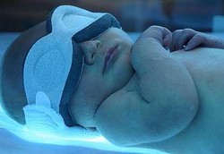 Waspadai Atresia Bilier Pada Bayi Kuning