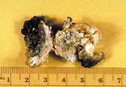 Yang Boleh dan Tak Boleh Bagi Penderita Batu Ginjal