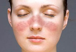 Dokter Sering Tertipu Lupus