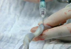 Cangkok Sel Induk, Mujarab Tapi Kontroversi