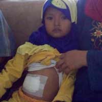 Penderita Kolostomi Tak Perlu Minder dan Malu