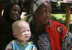 Albino di Afrika Diincar Dukun Jahat