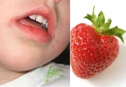 Bila Tubuh Alergi Stroberi