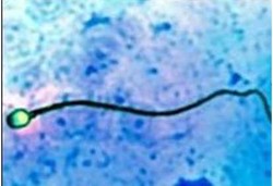 KB Baru Pria, Membunuh Sperma dengan Ultrasound