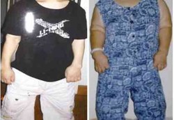 Manusia-manusia Mungil yang Terjebak Mutasi Gen