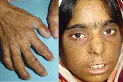 Penyakit Drakula dari Sisi Medis