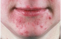 Acne Rosacea