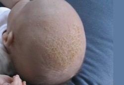 Menghilangkan Kerak di Kepala Bayi