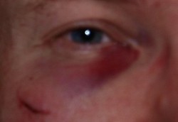 Tips Mengatasi Mata Lebam