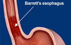 Barret Esophagus
