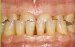 Bruxism: Gigi Gemerutuk