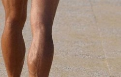 Penggumpalan Darah di Kaki