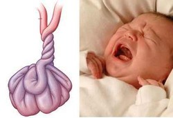 Muntah Hijau, Tanda Usus si Kecil Terpuntir