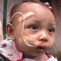 Minum Melalui Selang, Ihsan Tak Punya Langit Rongga Mulut