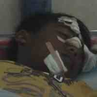 Tertancap Sapu Lidi, Mata Bocah SD Banyuwangi Terancam Buta