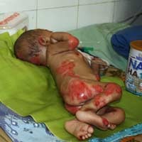 Baihaqi, Bayi Kulit Memerah dan Gizi Buruk Meninggal Dunia