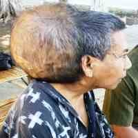 7 Tahun Kusnadi Melawan Tumor Seberat 6 Kg di Kepalanya