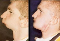 Bisakah Manusia Tanpa Rahang dan Dagu Bertahan Hidup?