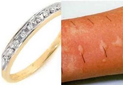 Nikel Pada Perhiasan yang Bikin Alergi