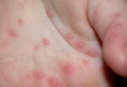 Macam-macam Ruam Merah Pada Bayi dan Artinya