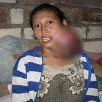 Derita Widarti dengan Benjolan Besar di Leher 