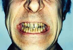 Kebiasaan yang Merusak Gigi