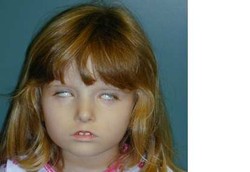 Tidak Bisa Tersenyum Karena Sindrom Moebius