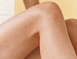 Cara Mudah Atasi Varises (Bagian 1)