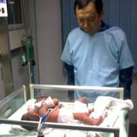 Bayi Kembar Siam Asal Gresik Tergolong Langka