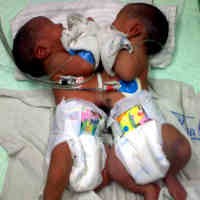 Kembar Siam Asal Gresik Hanya Jalani Pemeriksaan Darah