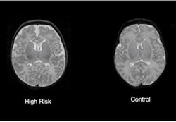 Tanda-tanda Skizofrenia di Otak Bayi