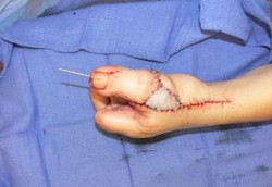 Bila Jempol Kaki Dipasang ke Jempol Tangan