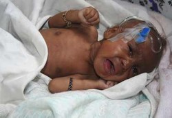 Kasus HIV Anak Indonesia Meningkat 700 Persen