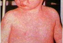 Penyakit Tampek Pada Anak Bisa Timbulkan Komplikasi Serius