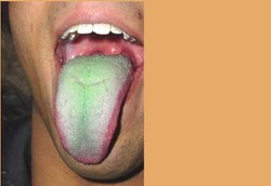 Bila Lidah Berwarna Hijau