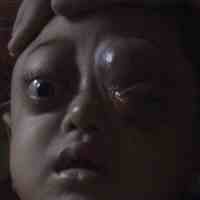 Jika Segera Dioperasi, Penglihatan Abidin Masih Berfungsi 