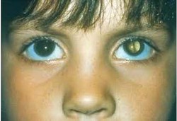 Anak Kecil Bisa Terkena Katarak
