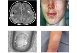 Penyakit Tumor Keturunan yang Sulit Didiagnosis