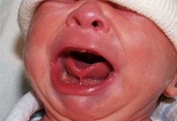 Pemotongan Tali Lidah Memudahkan Bayi Menyusu 