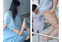 Lutut Kembali Normal Setelah 15 Tahun Menekuk ke Belakang 