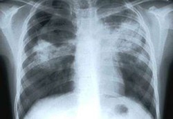 Memberantas TBC dengan Utang