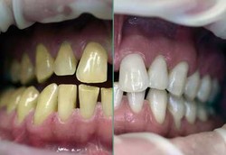 Untung Rugi Kesehatan dari Memutihkan Gigi