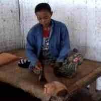 10 Tahun Busani Menderita Penyakit Kaki Gajah