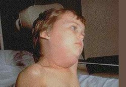 Jika Tak Ingin Mandul, Jangan Remehkan Gondongan