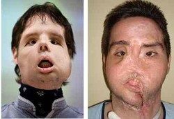 Permak Muka dengan Transplantasi Total Berhasil Dilakukan 