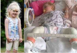 Baju Ketat Sembuhkan Balita dengan Sindrom Langka