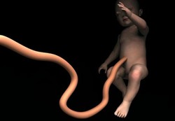 Bahaya Bayi Terlilit Tali Pusat